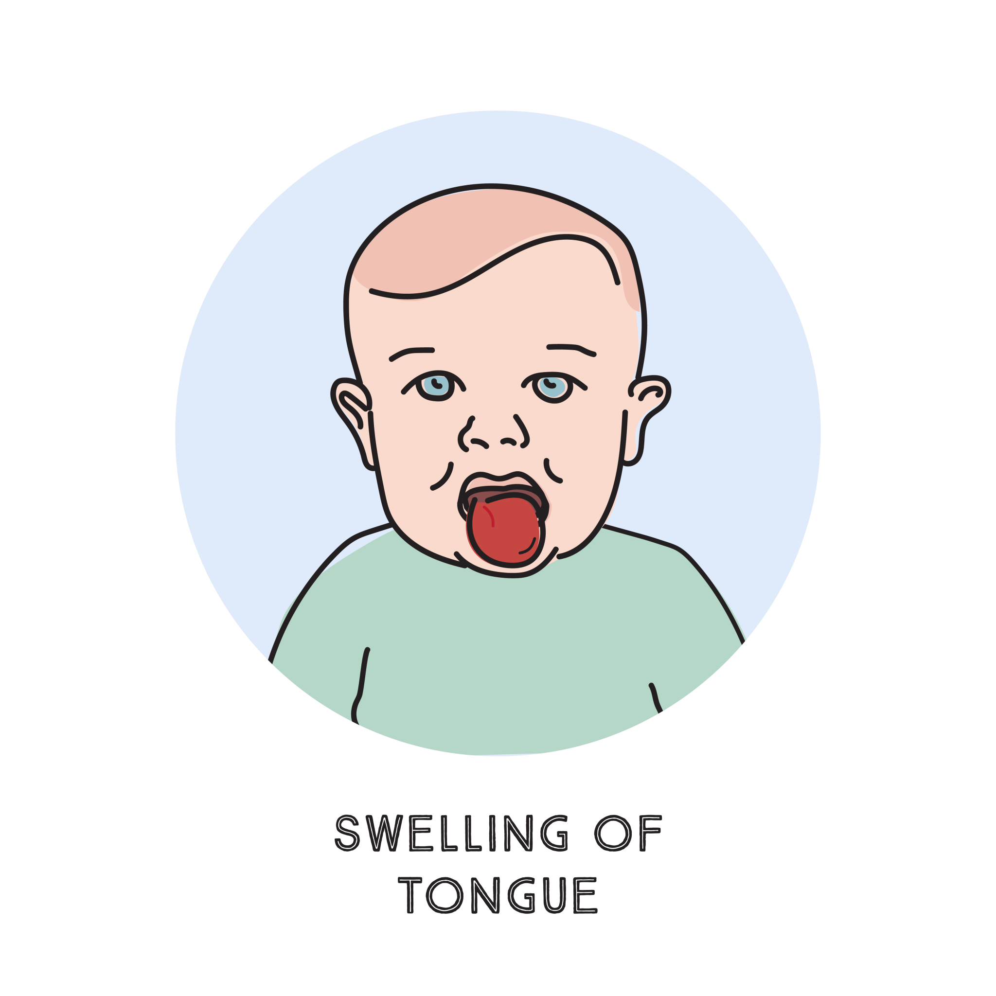 How to recognise an allergic reaction Prevent Allergies